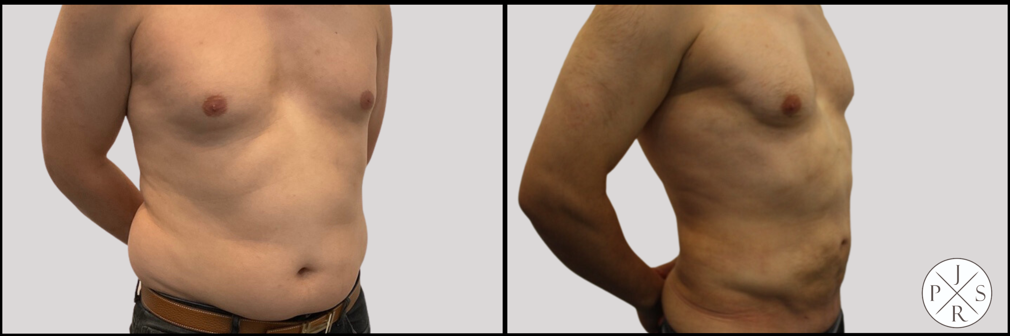 Liposuction Before & After Image